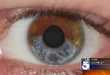 Eye-Lightening Elective Surgeries