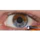 The Lumineyes Procedure Permanently Turns Brown Eyes Blue 1