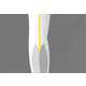 The FirstKind Geko Device Reduces Clotting 2