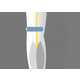 The FirstKind Geko Device Reduces Clotting 4