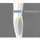 The FirstKind Geko Device Reduces Clotting 5