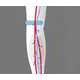 The FirstKind Geko Device Reduces Clotting 6
