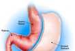 Getting a gastric bypass in Texas