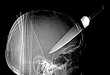 Funky X-Ray Findings